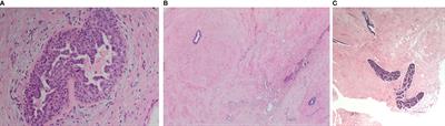 Morphological Features and Immunohistochemical Profiling of Male Breast Gynaecomastia; A Large Tissue Microarray Study